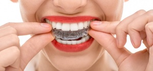 Invisalign San Antonio