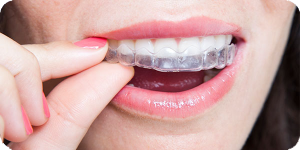 clear braces invisalign san antonio