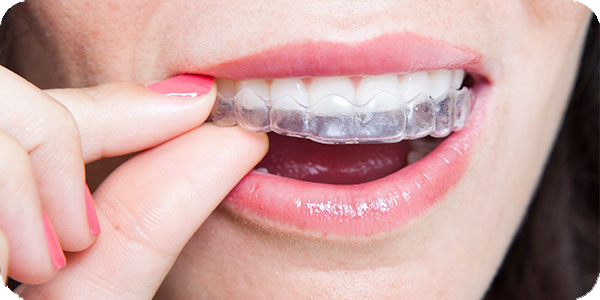 clear braces invisalign san antonio