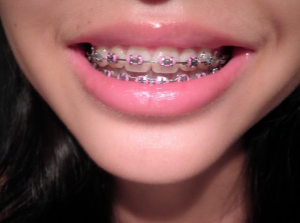 Invisalign clear braces san Antonio