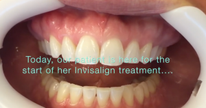 invisalign clear braces treatment san antonio